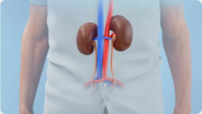 ¿Qué es el cáncer renal?